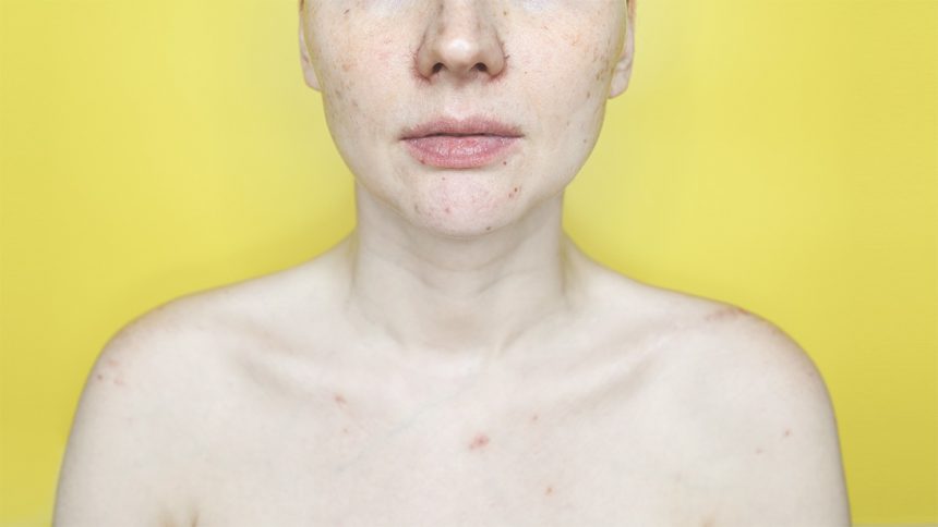 Купероз на обличчі: симптоми та лікування