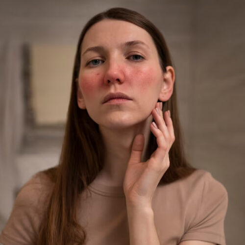 Системний червоний вовчак (СЧВ) – діагностика та лікування Системний червоний вовчак (СЧВ) – діагностика та лікування