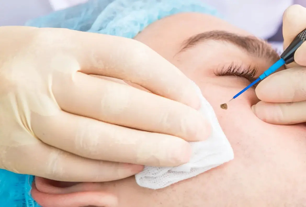 Радіохвильове видалення новоутворень Радіохвильове видалення новоутворень