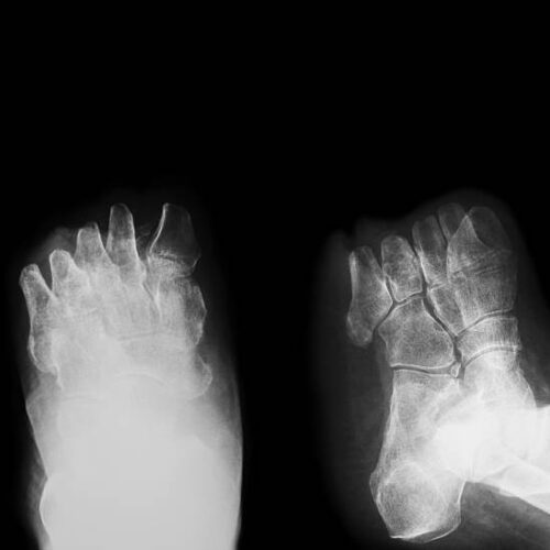 Що таке гангрена, як проявляється і чим загрожує