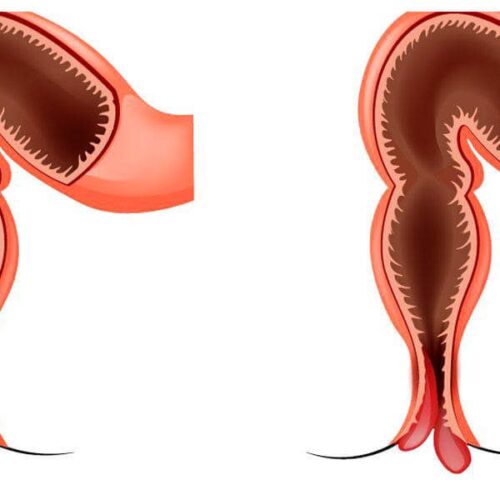 Випадіння прямої кишки (ректальний пролапс)
