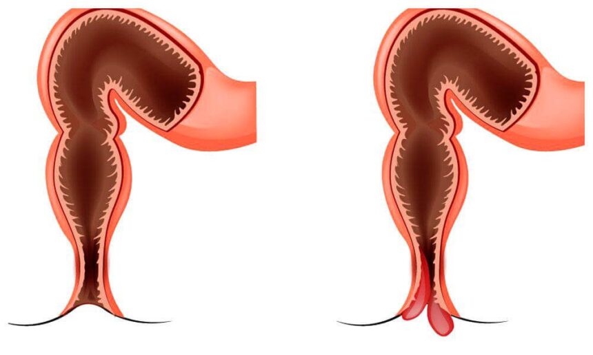 Випадіння прямої кишки (ректальний пролапс)